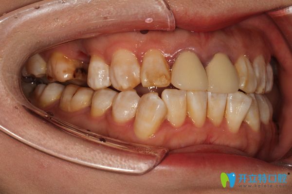 上頜右側(cè)牙齒缺失一顆圖示