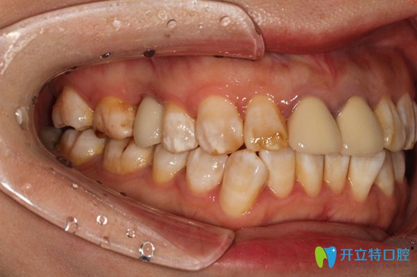 在廣州陽(yáng)光樹(shù)口腔戴上牙冠后樣子