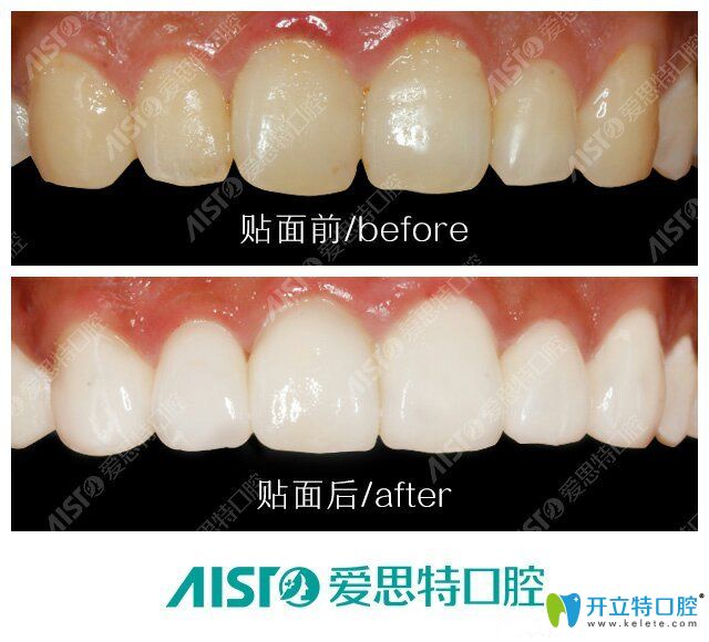 愛思特口腔牙齒貼面前后對比圖