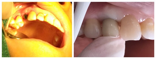 屌絲做完德國Bego種植體后的種牙使用體驗，瞅瞅他是咋說的