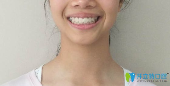 深覆合深覆蓋矯正好了的效果圖