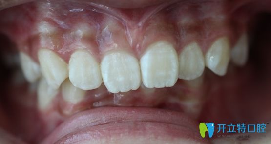 小A在廣州陽(yáng)光樹(shù)口腔做正畸術(shù)前的照片