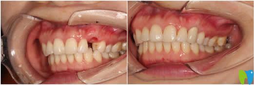 本姑娘做完種植牙后用事實告訴你美國3i種植體好不好