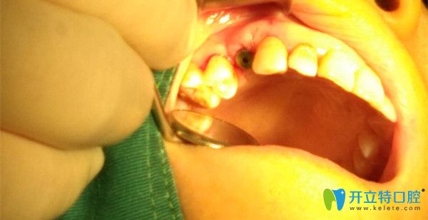 吳為我做手術(shù)中