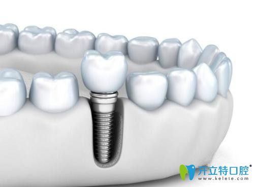 種植牙活動(dòng)