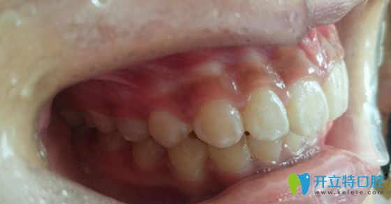 標(biāo)準(zhǔn)的牙齒咬合圖片