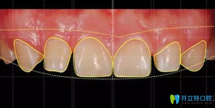 趙紫青表示牙齒貼面要考慮美學因素