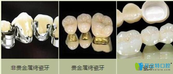 烤瓷牙種類(lèi)