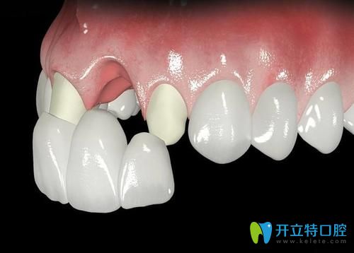 長沙中諾口腔鈷鉻合金烤瓷牙