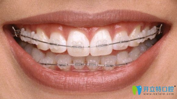 北京圣貝牙科的日本Tomy陶瓷自鎖矯正特價(jià)27800元起!活動(dòng)屬實(shí)