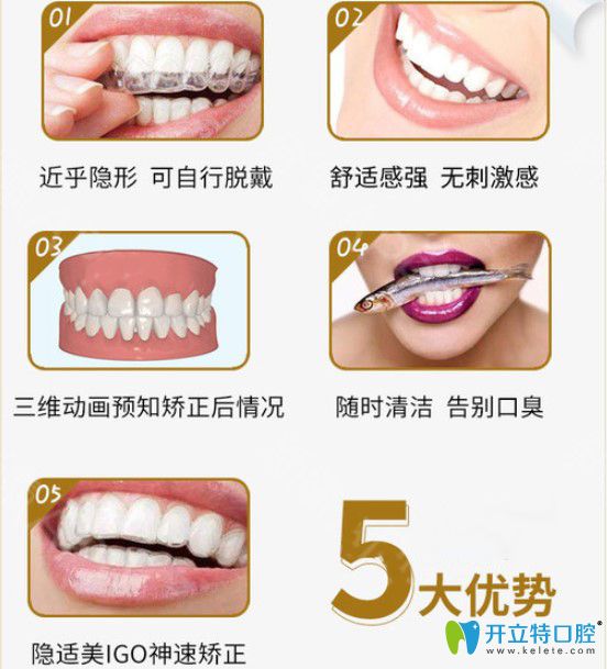 隱適美IGO隱形矯正優(yōu)勢