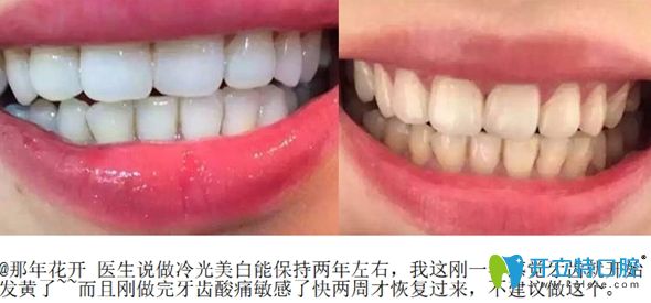 冷光美白牙齒一年后的效果圖