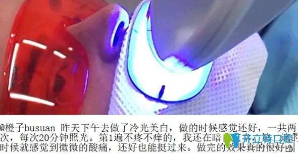 做冷光美白牙齒的過程圖