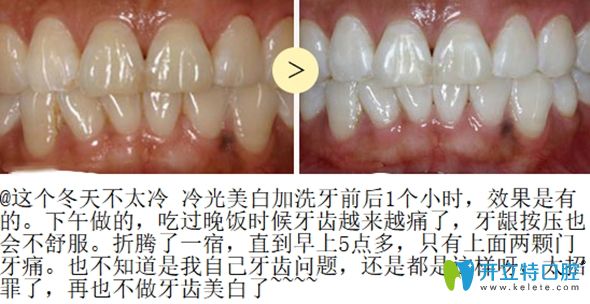 冷光美白前后效果對比圖