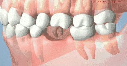 缺牙不補(bǔ)的危害