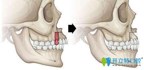 拔牙后前后對(duì)比