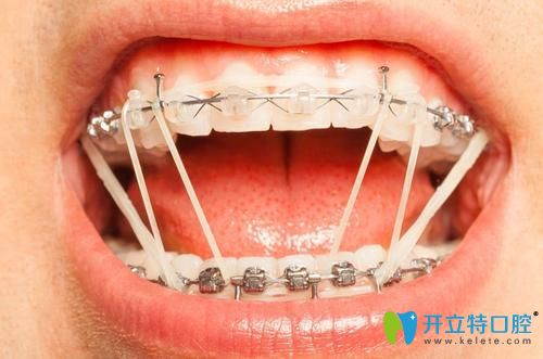 what？有人疑惑正畸橡皮筋吃飯刷牙時(shí)還得拿下來么