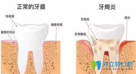 正常的牙齒和牙周炎