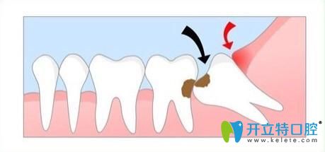 矯正時(shí)候需要拔掉齲齒