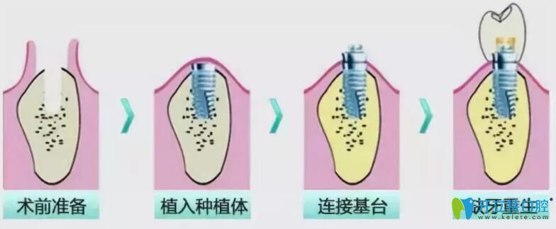 即拔即種和種植牙的區(qū)別,其實(shí)是對的時(shí)機(jī)遇見對的牙齒條件