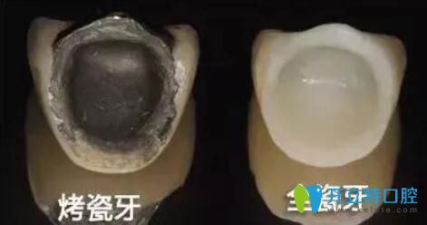 別只關(guān)心價格,德國西諾德全瓷牙好不好,看看內(nèi)行人的分析