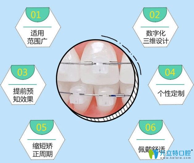 美國ormco陶瓷自鎖托槽矯正優(yōu)勢