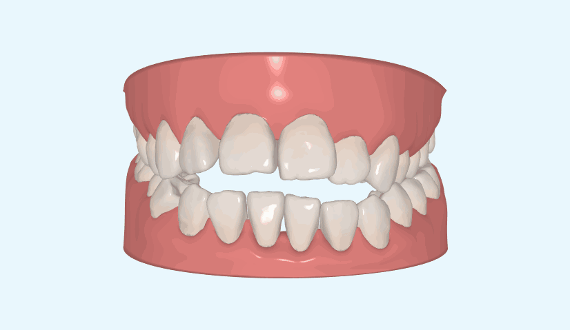 泰國這么多人帶牙套的原因難道是矯正牙齒的價格很便宜嗎