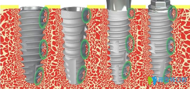 韓國(guó)neo種植體缺點(diǎn)