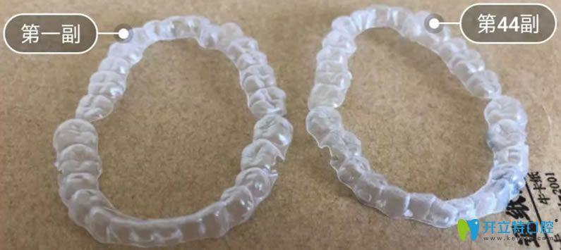 美奧口腔隱適美隱形牙套