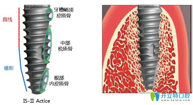 韓國(guó)紐百特種植體優(yōu)點(diǎn)