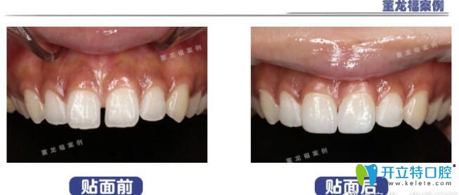 關(guān)閉門(mén)牙縫隙,貼面or牙齒矯正?我pick了超薄瓷貼面