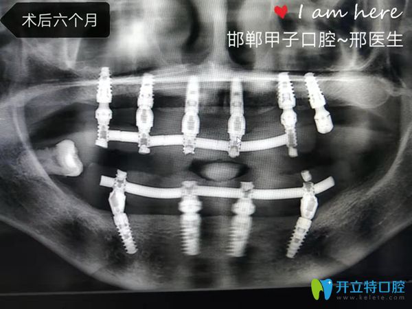 劉阿姨術后6個月片子