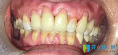 張阿姨楔狀缺損修復(fù)后