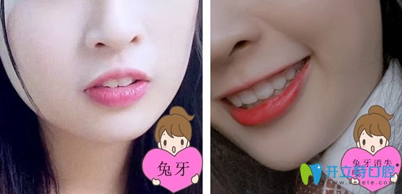 突嘴小姐姐在牙祖口腔矯正前后效果圖