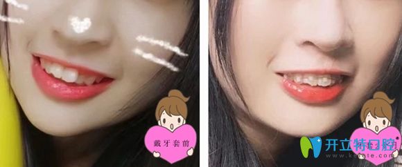 戴ormco陶瓷自鎖托槽矯正一個(gè)月后效果