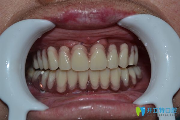 裝上種植牙后圖片