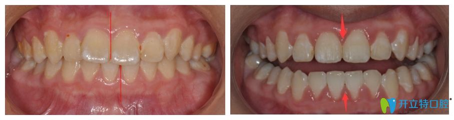 廣大口腔美國(guó)Ormco自鎖托槽矯正案例效果圖