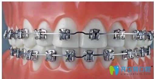 廣大口腔美國(guó)Ormco（DamonQ）金屬自鎖托槽正畸