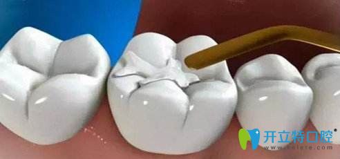 只需要一次治療就可以補好牙