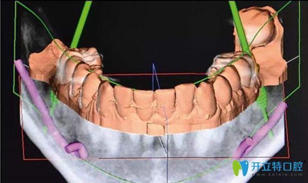 數(shù)字化種植技術(shù) 數(shù)字化種植技術(shù)