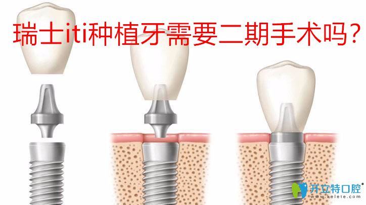 還以為瑞士iti種植牙需要二期手術(shù)呢,那就大錯特錯了
