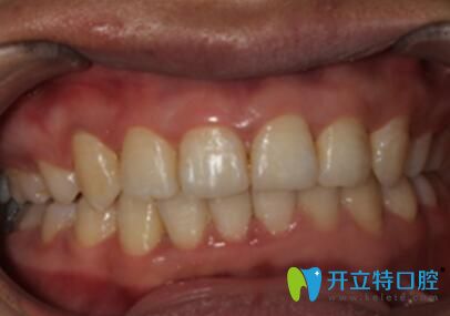 在蘭州諾貝爾口腔做深覆合牙齒矯正后的照片 在蘭州諾貝爾口腔做深覆合牙齒矯正后的照片