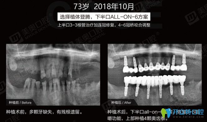 多顆牙缺失后做半口all-on-6種植 多顆牙缺失后做半口all-on-6種植