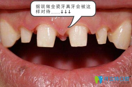 有醫(yī)生建議做美容冠但害怕被磨牙而拒絕