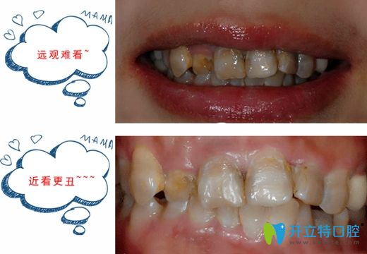 在合肥壹加壹口腔做矯正和貼面前的牙齒照