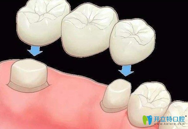 修大夫口腔蘇明坤醫(yī)生解析：固定義齒修復(fù)有哪些優(yōu)缺點(diǎn)
