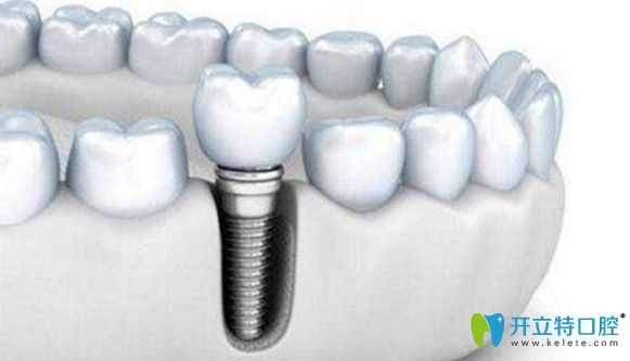種牙后要定期檢查復(fù)診