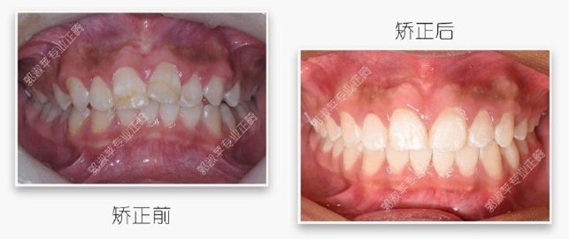 深覆蓋矯正經(jīng)歷證實(shí)：隱適美在推磨牙后移方面的效果不錯(cuò)