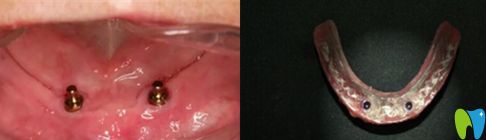 球帽式覆蓋義齒