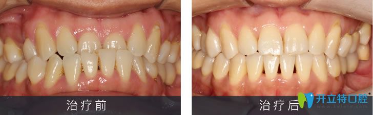 小姐姐個(gè)別門牙反頜經(jīng)美國(guó)3m自鎖托槽矯正后下巴終于歸位了